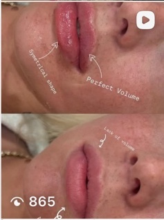 EllaVate lip treatment result