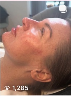 EllaVate skin treatment result